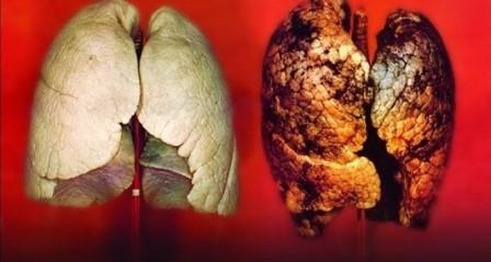 Akciğer kanserlerinin yaklaşık yüzde 90’ı tütün ve tütün ürünlerinin kullanımı ile oluşuyor